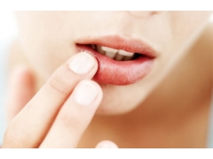 用艾艾贴如何调理慢性唇炎？