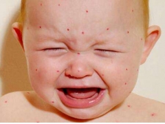 小儿水痘可以用艾艾贴吗？