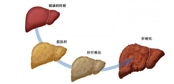 艾艾贴能不能调理脂肪肝？