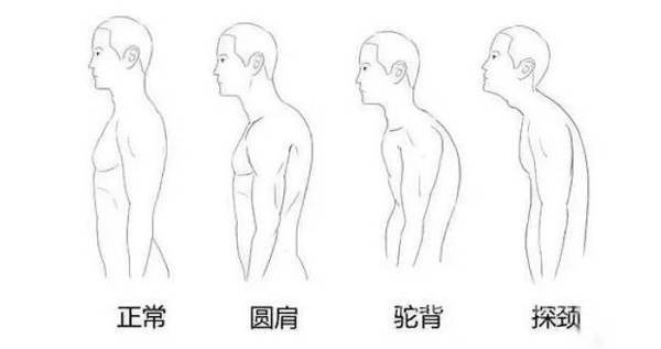 青年性驼背症能不能用艾艾贴调理？